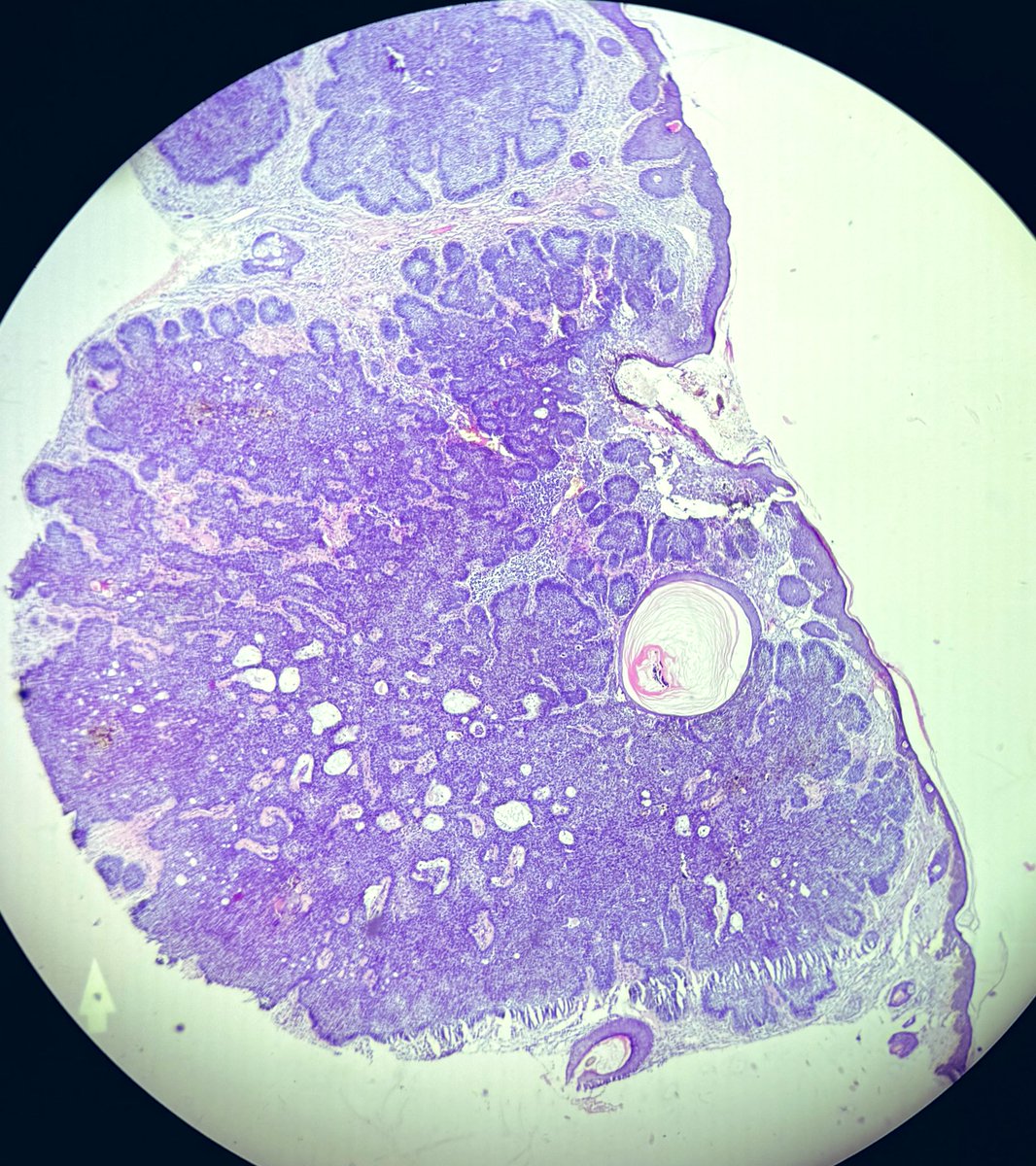 Drmona1995's tweet photo. 75 F. Lesion over forehead 15 years
Image 1: showing origin of the tumour from the skin lining.
Image 2&3: Beautiful Basaloid cells with microcysts in between.
Image 4: showing Melanin Pigment.
What am i?
#dermatopath #histology #pathology https://t.co/IWFMuPiGeo