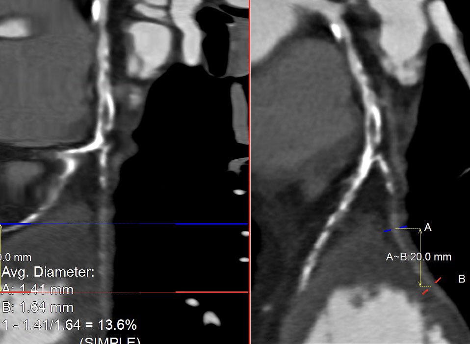 Recent #CTOPCI - surgical turndown, LVEF 20%.

CCTA for mapping &amp; plaque evaluation ➡️ CTO ~30mm, heavy Ca+, distal bifurcation. No R-&gt;L collaterals. 

PCI: impella supported, #AWE crossed IP w/ Gaia 3 ➡️ 1.25mm rota to mid segment ➡️ IVUS ➡️NC/CB ➡️ DESx 3 to LAD ostium

#CHIP