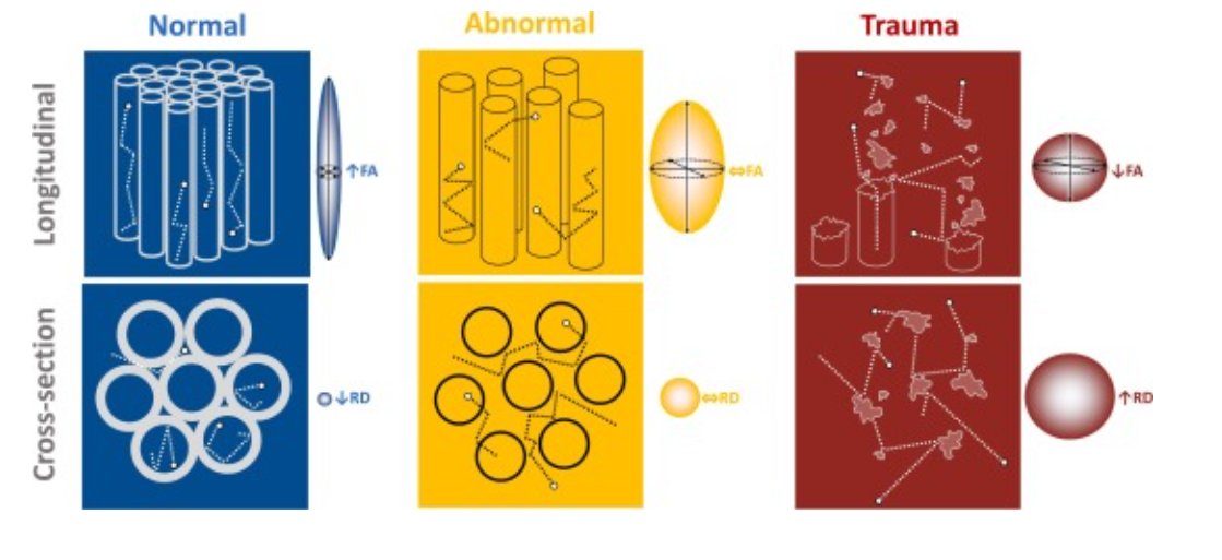 eic_nic's tweet image. Diffusion tensor imaging at 3T for diagnosing root avulsion in adults with acute traumatic brachial plexus injuries
New work from Wade and colleagues:
sciencedirect.com/science/articl…