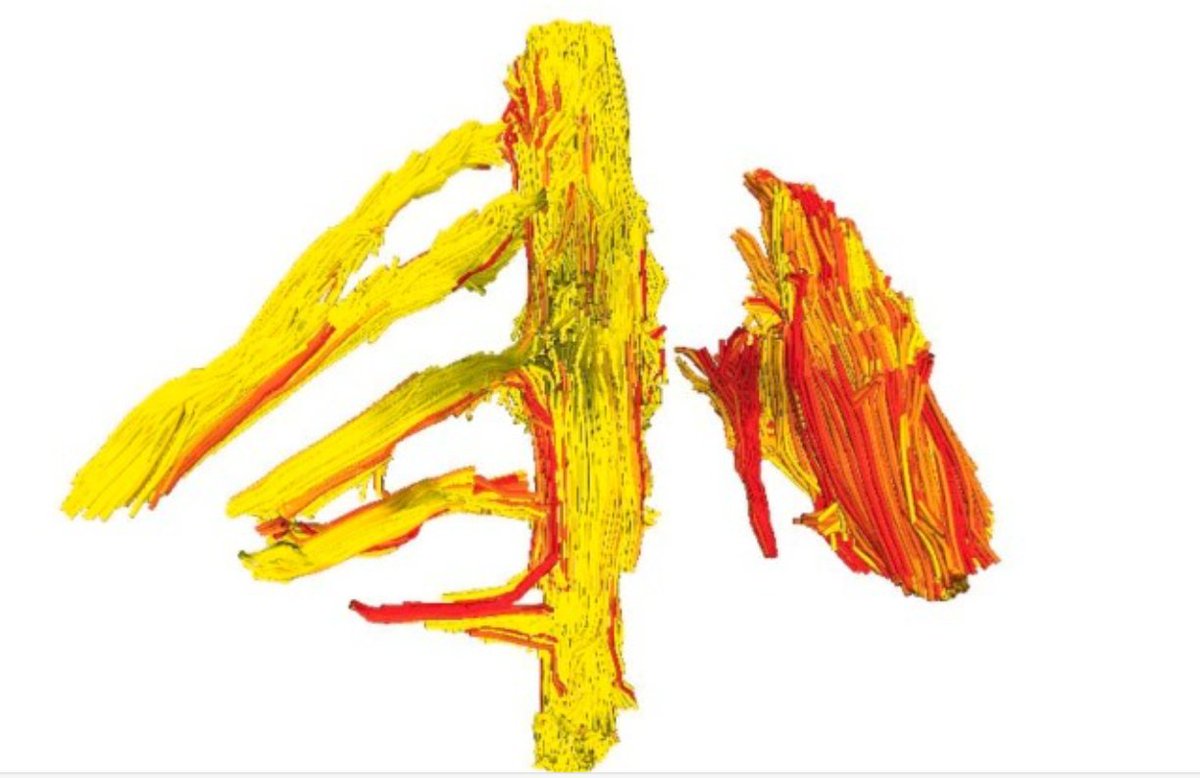 eic_nic's tweet image. Diffusion tensor imaging at 3T for diagnosing root avulsion in adults with acute traumatic brachial plexus injuries
New work from Wade and colleagues:
sciencedirect.com/science/articl…