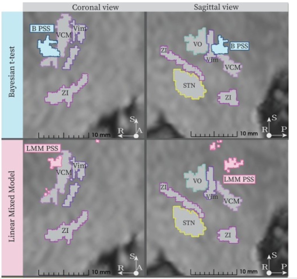 eic_nic's tweet image. NEW work on DBS electrode optimization:
Influence of statistical approaches on Probabilistic Sweet Spots computation in Deep Brain Stimulation for severe Essential Tremor
Work by Vittoria Bucciarelli and team:
sciencedirect.com/science/articl…