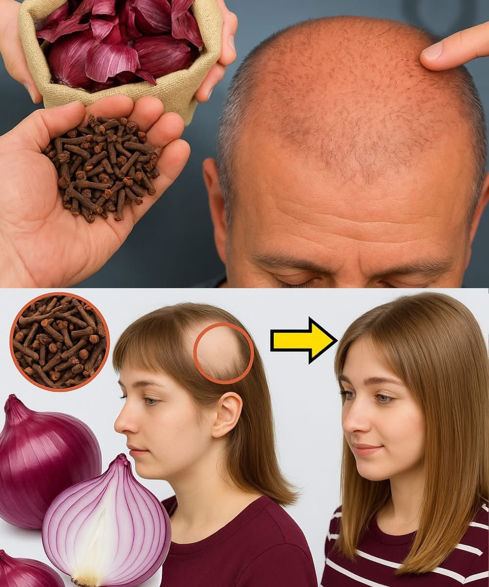 Onion Husk and Clove: A Super Remedy for Baldness
Preparation:
Take 2 tablespoons of dried onion husks and 1 tablespoon of cloves.
Boil 2 cups of water.
Add onion husks and cloves to the boiling water.
Let it simmer for 10-15 minutes.
Cool the mixture, strain, and store in a