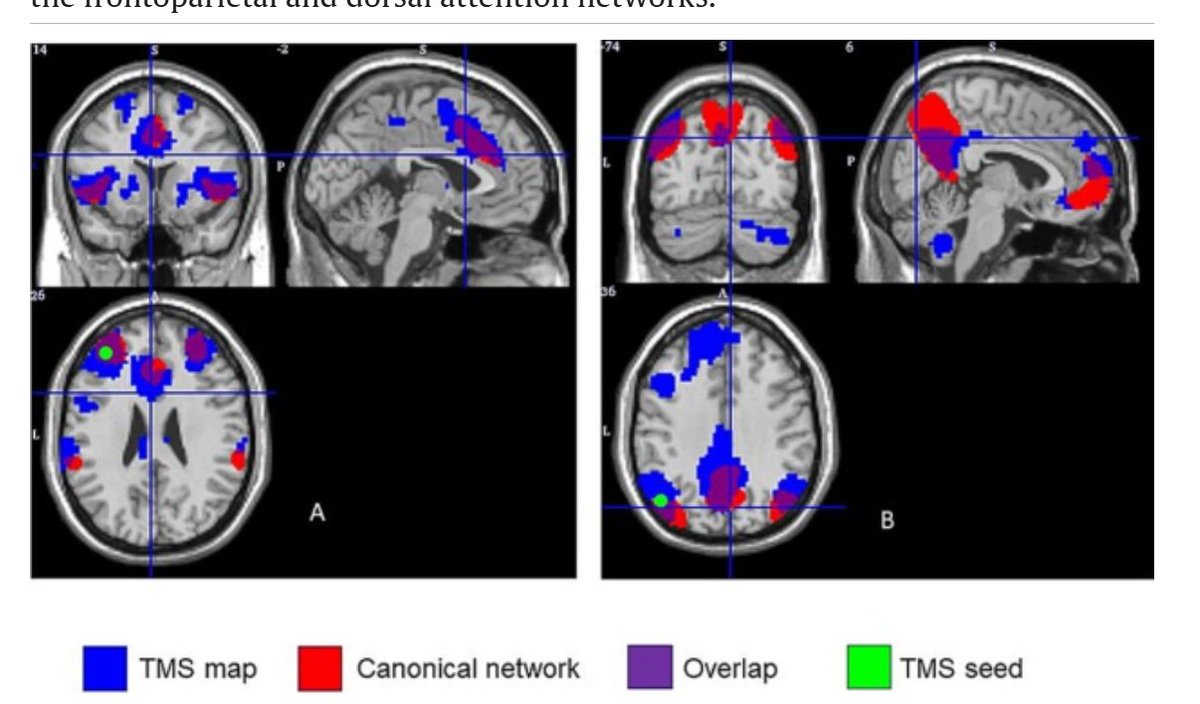 eic_nic's tweet image. IMPROVING THE PRECISON OF TMS:
Network-targeted transcranial magnetic stimulation (TMS) for mild cognitive impairment (MCI)
Work by Joy Taylor and colleagues:
sciencedirect.com/science/articl…