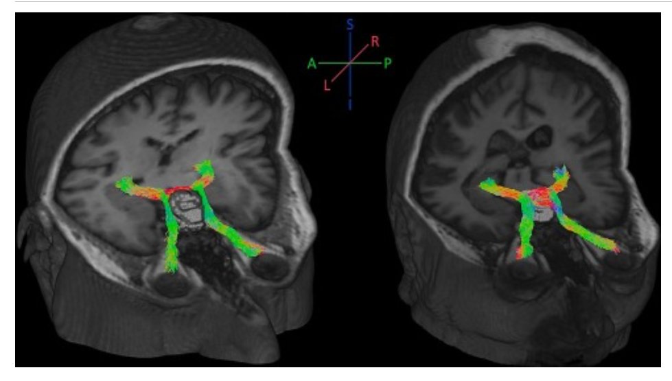 eic_nic's tweet image. Important advance for tracking the optic pathway:
Fully automated pipeline for the fiber tractography of the anterior optic pathway in patients with sellar and parasellar tumors and analysis of the microstructural alterations
Work by Laura Gramegna:
sciencedirect.com/science/articl…