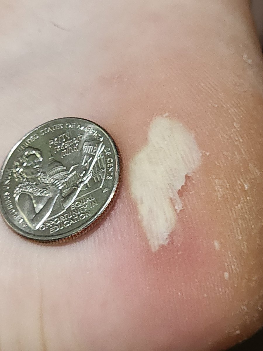 hypospadias tweet media