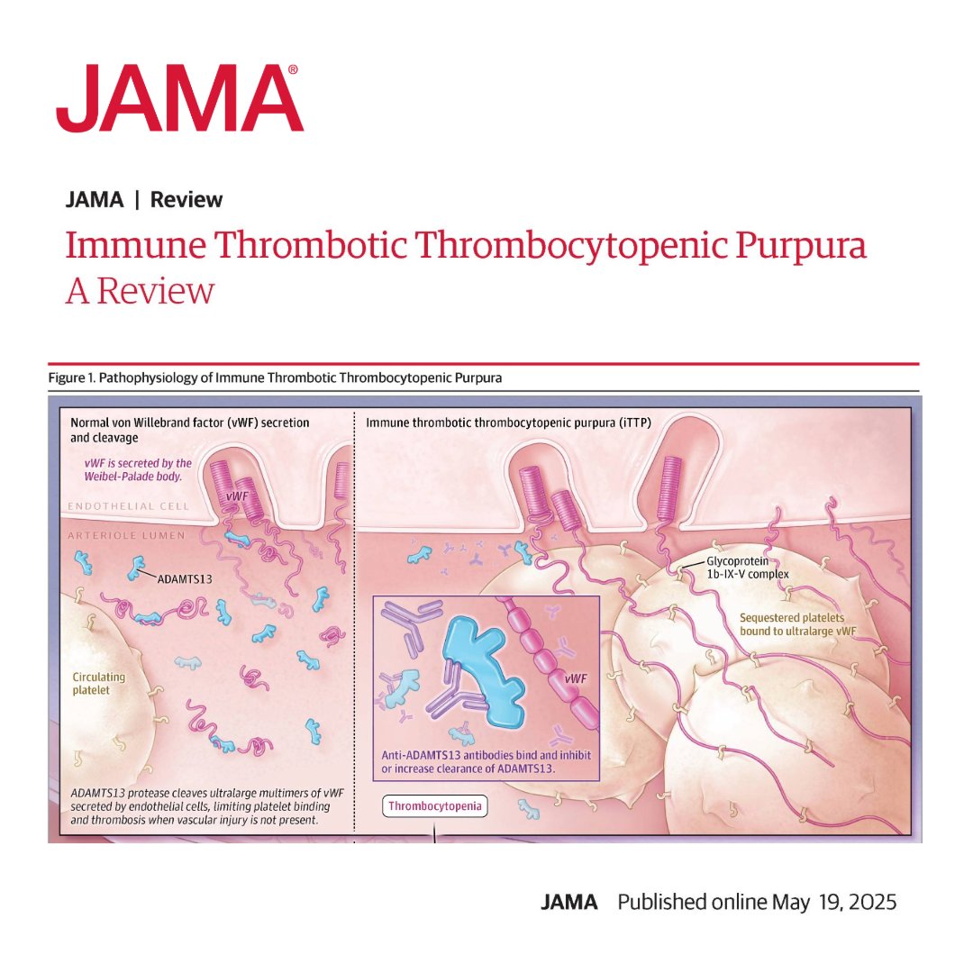 Immune thrombotic thrombocytopenic purpura (iTTP) is a rare immune-mediated disorder characterized by thrombocytopenia and microangiopathic hemolytic anemia, potentially causing life-threatening thrombosis. 

Learn more in this Review. 

ja.ma/4kpV7MZ