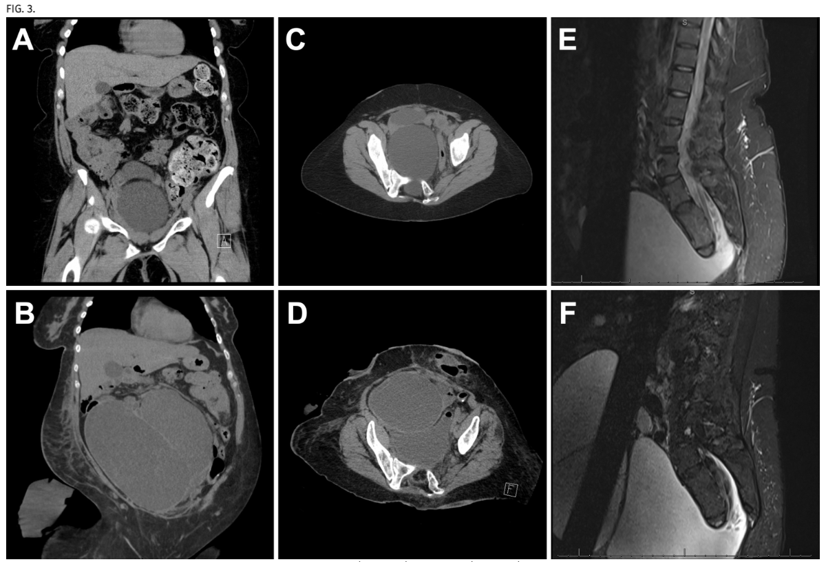 TheJNS's tweet image. #JNSCaseLessons. Authors highlight rare case of anterior sacral meningocele with concurrent Currarino syndrome and caudal duplication anomaly.
thejns.org/caselessons/vi…