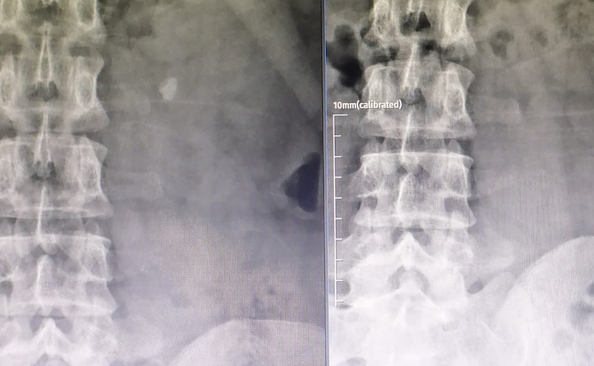 ZERO invasiveness!! What else a patient can expect from a treatment to get rid of the stone in such a quick and practical manner. No need for well-known invasive procedures under anesthesia as the first option.SWL is still alive and active with GL's based certain indications.