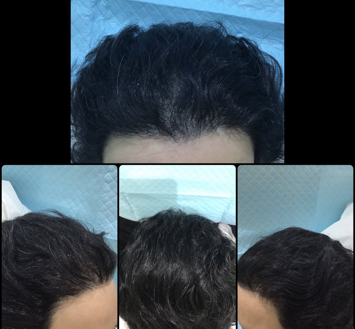 قبل وبعد عملية زراعة الشعر بـ ١٠ أشهر 😍

زراعة الشعر للنساء تعتبر من العمليات الدقيقة وفيها تفاصيل مختلفة وتتم بدون حلاقة للمنطقة المزروعة

الحرص على محاكاة الطبيعي وعدم المبالغة في تنزيل الخط الأمامي تعطي نتائج مميزة 👏