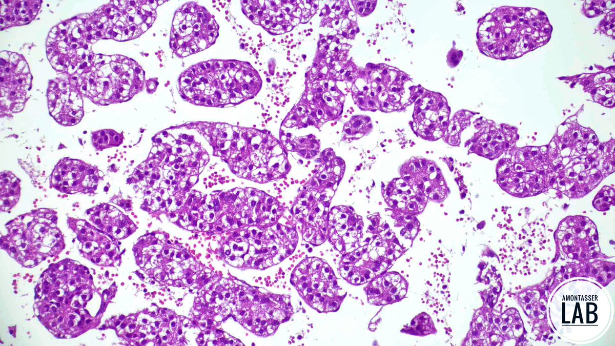 AMontasserMD's tweet image. Osteolytic lesion C1-2
Do you need IHC? 🙂↔️
#IHC #Pathology #PathX