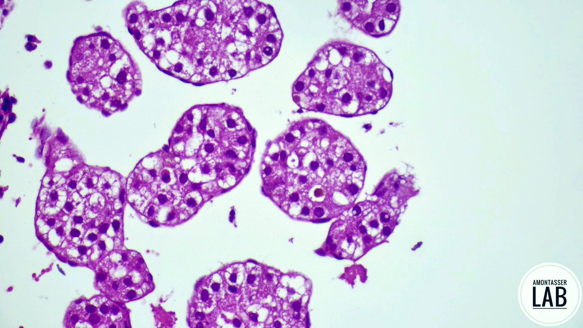 AMontasserMD's tweet image. Osteolytic lesion C1-2
Do you need IHC? 🙂↔️
#IHC #Pathology #PathX
