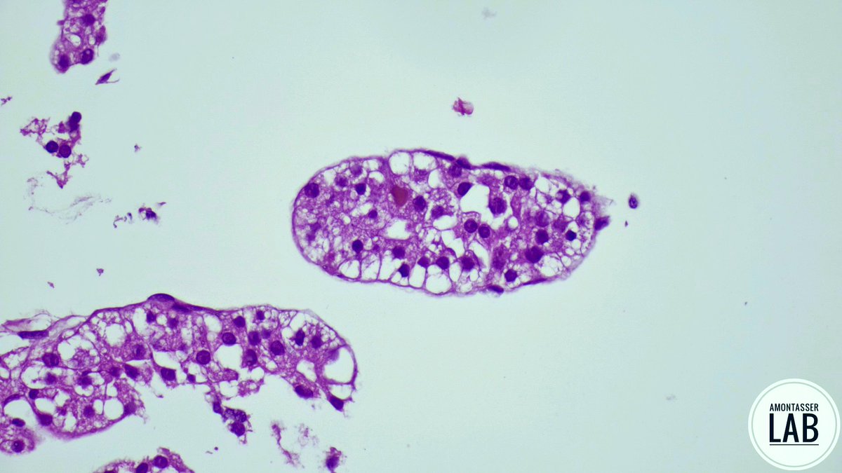 AMontasserMD's tweet image. Osteolytic lesion C1-2
Do you need IHC? 🙂↔️
#IHC #Pathology #PathX