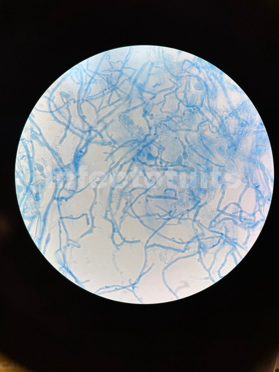 infectotuits's tweet image. Les tenemos el #FF #FungiFriday
Schizophyllum commune
Noten ustedes: en el macro la colonia en forma de “lana” y en la tinción las hifas vialidad con las conexiones que permiten unir las ramificaciones y sus hifas espiculadas.
Un microorganismo del phylum Basidiomicota.