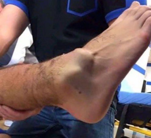 Musiala will likely be out for 4-5 months
[<a href="/FabrizioRomano/">Fabrizio Romano</a> ]