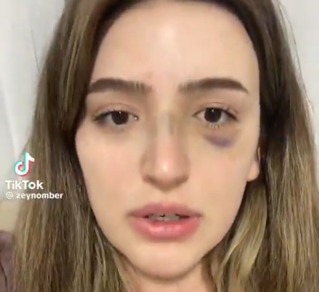 zeynep teğmen eşi tarafından darp edilmiş ve maalesef vücudunda kalıcı ve ciddi hasarlara yol açmış, dava aşamasında ve sesini duyurmamızı istiyor.

#ZeynepYalnızDeğildir tagı mente bırakalım lütfen