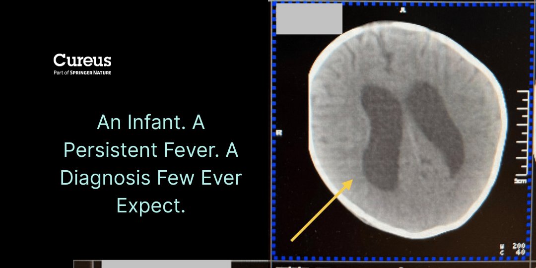 A 5-month-old with unrelenting fever. The surprise? Dual diagnosis: C. difficile &amp; P. aeruginosa meningitis. Rare. Deadly. Life-saving diagnosis.

Read the full case here: hubs.la/Q03vVDC-0

#Cureus #Pediatrics #InfectiousDiseases #CDI #Meningitis