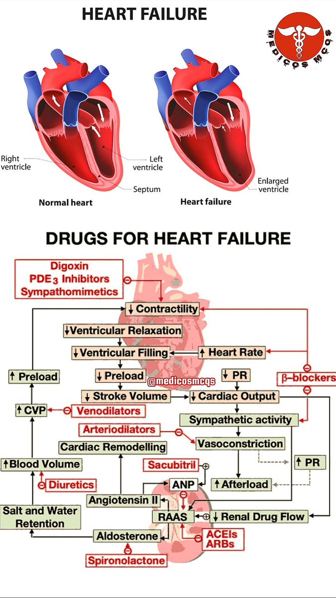 AB_drmd's tweet photo. فشل القلب او ال Heart Failure مو معناه ان القلب وقف تمامًا، لا! بس صار كسول ومتعب شوي. خلنا نتكلم عن كيف شكل القلب الطبيعي مقابل القلب المتعب، وكيف الأدوية تحاول تساعده يرجع يشتغل أو على الأقل يوقف من الانهيار:

❤️ أول شيء: الفرق بين القلب الطبيعي و Heart Failure
القلب الطبيعي مشدود ومضبوط، يدخ الدم بقوة من البطينين (Right & Left ventricles). أما في Heart Failure، البطين الأيسر يتضخم (Enlarged ventricle) ويحاول يعوّض لكن ما يقدر يضخ بقوة، فتنقص كمية الدم اللي توصل للجسم.
🔄 النتيجة؟ التعب، ضيق تنفس، احتباس سوائل، وأحيانًا الموت لو ما تعالج.

💊 خلنا نبدأ نفهم الأدوية واحد واحد:
🧠 الموضوع مثل شجرة قرارات داخل القلب، وكل دواء يدخل يلعب دور:
1. Digoxin + PDE3 Inhibitors + Sympathomimetics
هذولا الثلاثة يحاولون يرفعون القوة الانقباضية للقلب (↑Contractility) حتى يعوض الضعف في الضخ، ويزيدون الـ Cardiac Output شوي، خصوصًا لما القلب يكون فاشل بشدة.

2. β-blockers
هذولا أبطال التهدئة 🧘‍♂️، يقللون معدل ضربات القلب (↓Heart Rate) ويقللون ضغط الدم (↓PR)، ويحمون القلب من التوتر المزمن. بس لازم تعطيهم لما المريض يكون stable، لأنهم بالبداية ممكن يسوء الوضع لو استخدمناهم غلط.

3. ACEIs و ARBs
هذولا يوقفون RAAS (اللي هو نظام الرينين-أنجيوتنسين)، وبالتالي ↓Angiotensin II → ↓Aldosterone → ↓احتباس الملح والمويه. كذا نخفف الـ Preload وAfterload، ونمنع التليّف (Cardiac remodeling) اللي يخرب القلب زيادة.

4. Spironolactone
دواء مدر للبول ويشتغل كمضاد لـ Aldosterone، ينفع لما القلب يوصل مراحل متقدمة، يقلل الـ Blood volume ويمنع زيادة الـ CVP.

5. Sacubitril
يشتغل على ANP (اللي هو هرمون طبيعي يفرزه القلب عشان يتخلص من المويه والملح). يشتغل مع Valsartan كدواء اسمه Entresto، ممتاز في تحسين البقاء على قيد الحياة في Heart Failure 👏

6. Diuretics
زي Furosemide، تسحب المويه الزايدة من الجسم، تقلل الأعراض مثل ضيق التنفس والتورّم. ما تطول عمر المريض لكنها تخليه يحس بتحسن بسرعة!

7. Venodilators و Arteriolodilators
زي Nitrates وHydralazine، يقللون الـ Preload وAfterload، ويخففون الضغط على القلب.