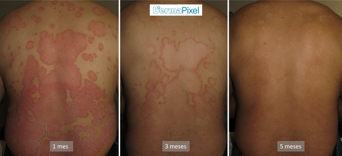Rosa Taberner (@rosataberner) on Twitter photo Esta semana en <a href="/dermapixel/">Dermapixel</a> le damos un repaso al tratamiento sistémico clásico de la #psoriasis. Los biológicos, los dejamos para otro día (prometido).
dermapixel.com/2025/07/el-tra…
#dermatología <a href="/accionpsoriasis/">Acción Psoriasis</a> Esta semana en <a href="/dermapixel/">Dermapixel</a> le damos un repaso al tratamiento sistémico clásico de la #psoriasis. Los biológicos, los dejamos para otro día (prometido).
dermapixel.com/2025/07/el-tra…
#dermatología <a href="/accionpsoriasis/">Acción Psoriasis</a>