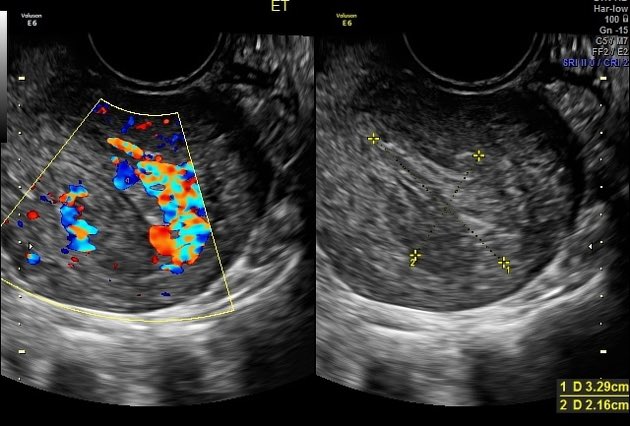 متى نحتاج لعمليه التنظيف بعد الاجهاض ؟ 

إذا فيه العلامات التالية:
♦️نزيف رحمي

♦️حجم الانسجة الباقية > ١٥ ملم

♦️تدفق دموي  نشط باشعه دوبلر 

#ثقافتك_تحميك