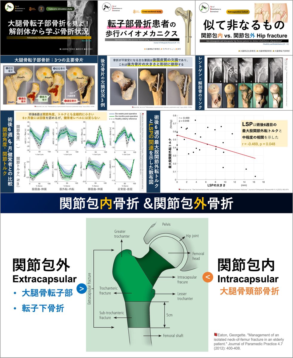 転子部骨折後の歩行の予後予測💡
骨折型ごとの鍛えるべき筋力箇所！

転子部骨折関連の文献抄読を共有しますᯤ
■...を見よ！：note.com/super_human/n/…
■歩行バイオメカ：note.com/super_human/n/…
■似て非なるもの：note.com/super_human/n/…

リハ内容に示唆を与える重要な知識ですね😲