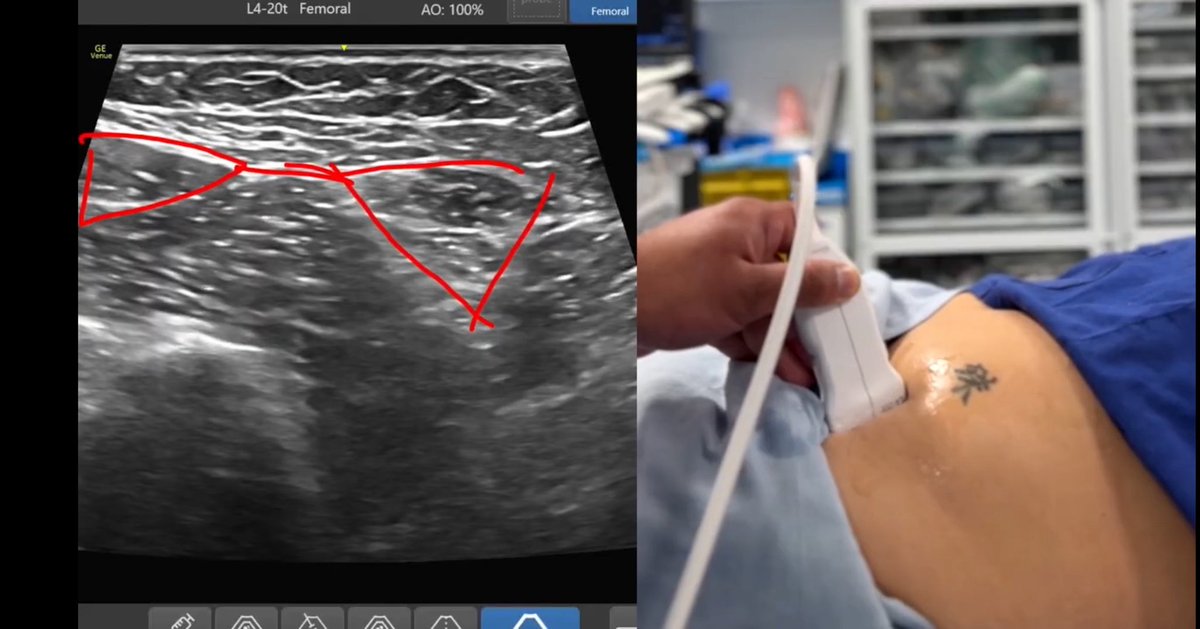 Dr Amit Pawa💉🎙️ (@amit_pawa) on Twitter photo Hey Folks -
I uploaded a new short scanning video to show you a rapid way to scan for the SupraInguinal Fascia iliaca (SIFI) block
Simple scanning as if at a workshop- with the added bonus of the “Scribble tool” from the <a href="/GEHealthCare/">GE HealthCare</a> #VenueFamily
youtu.be/fHgO4dczWFk?si… Hey Folks -
I uploaded a new short scanning video to show you a rapid way to scan for the SupraInguinal Fascia iliaca (SIFI) block
Simple scanning as if at a workshop- with the added bonus of the “Scribble tool” from the <a href="/GEHealthCare/">GE HealthCare</a> #VenueFamily
youtu.be/fHgO4dczWFk?si…