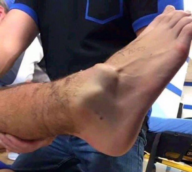 Tsportsanalysis's tweet image. 🚨 BREAKING: Bayern Munich's star midfielder Jamal Musiala faces a significant setback with a fractured left fibula and multiple ligament injuries according to BILD. 
The young talent is expected to be sidelined for 4-5 months. 🏥⚽ 

#getwellsoonmusiala #ClubWorldCup