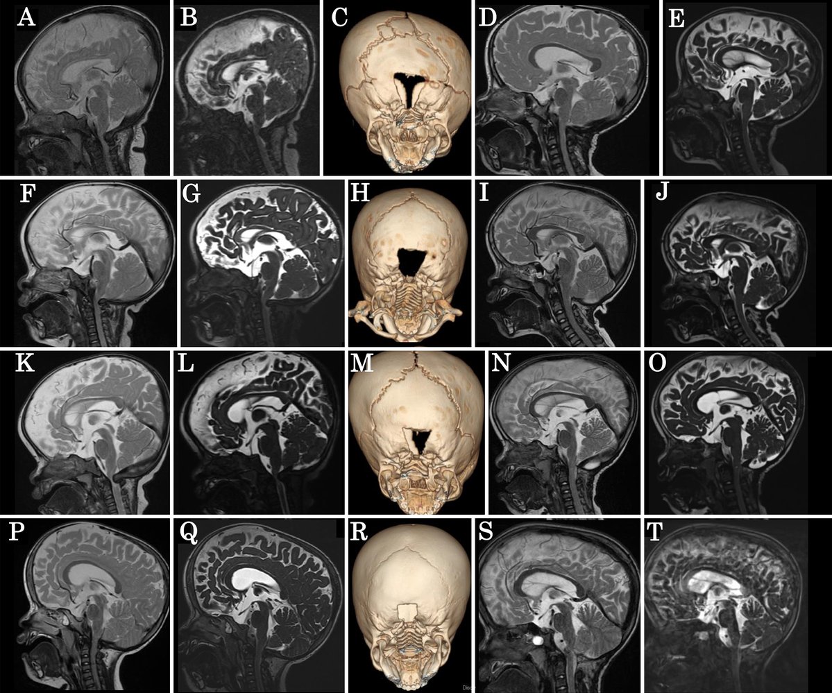 TheJNS's tweet image. #OnlineFirst: Sleep apnea in patients with achondroplasia associated with foramen magnum stenosis
thejns.org/pediatrics/vie…