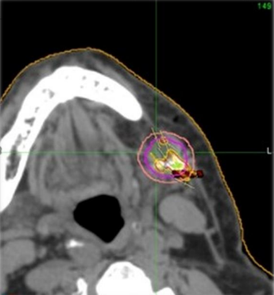 A 96-year-old with Stage IV SCC, ECOG 3, cardiac history, and dementia - not a candidate for surgery or combo therapy - achieved NED at 25 months after one Alpha DaRT® insertion + later anti-PD1.

➡️ Intratumoral first. Systemic second.

linkedin.com/posts/alphatau…
