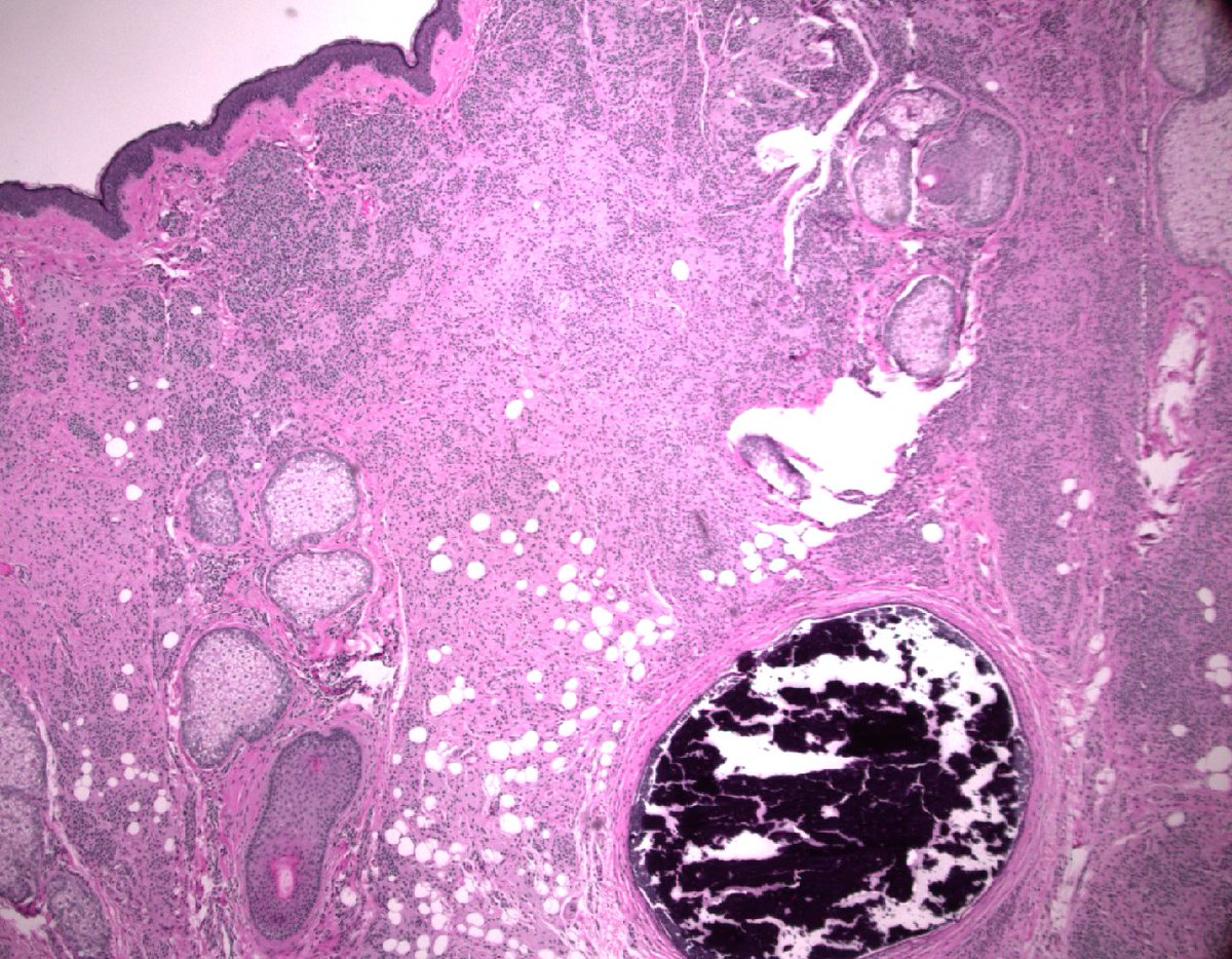 STEVENKOLKERMD's tweet photo. A blob of dystrophic calcification within a nevus.  If Nanta can do it with bone, I think I do it with this calcification.  I will call it Nevus of Kolker https://t.co/wawJ5jUhOM