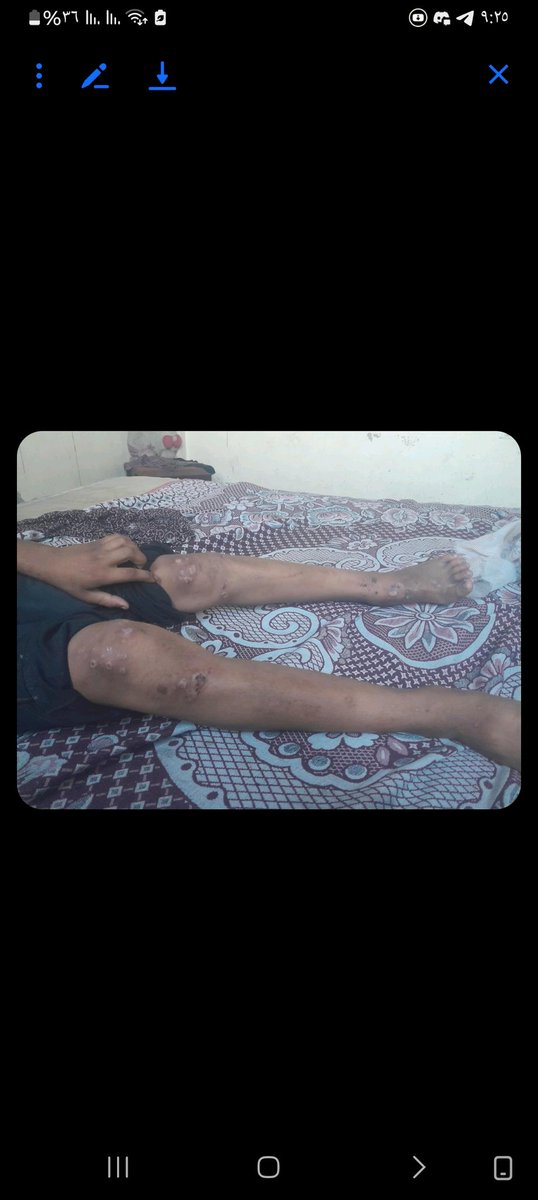 WfaMtr64836's tweet image. Je suis votre sœur Wafaa et voici mon fils Waseem. Il souffre d'une maladie de peau et a besoin de soins. Il n'arrive pas à dormir. Faites un don. chuffed.org/project/126993…