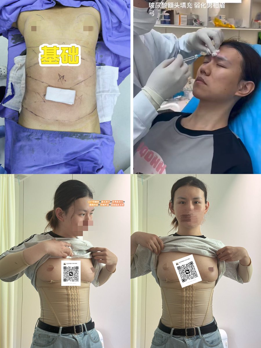 腰腹环吸➕手臂环吸➕双眼皮➕面部女性化针剂填充➕自体脂肪丰胸

+v bethebeauty12345 領取內部底價表 （私信不回復）MTF 面部女性化隆胸豐臀抽脂皮膚科牙科磨骨
咨询v：bethebeauty12345 

mtf #ts #雌二醇 #雌激素 #补佳乐 #克龄蒙 #爱斯妥 #凝胶 #色普龙 #华典 #比卡鲁胺 
#药娘 #伪娘 #变性