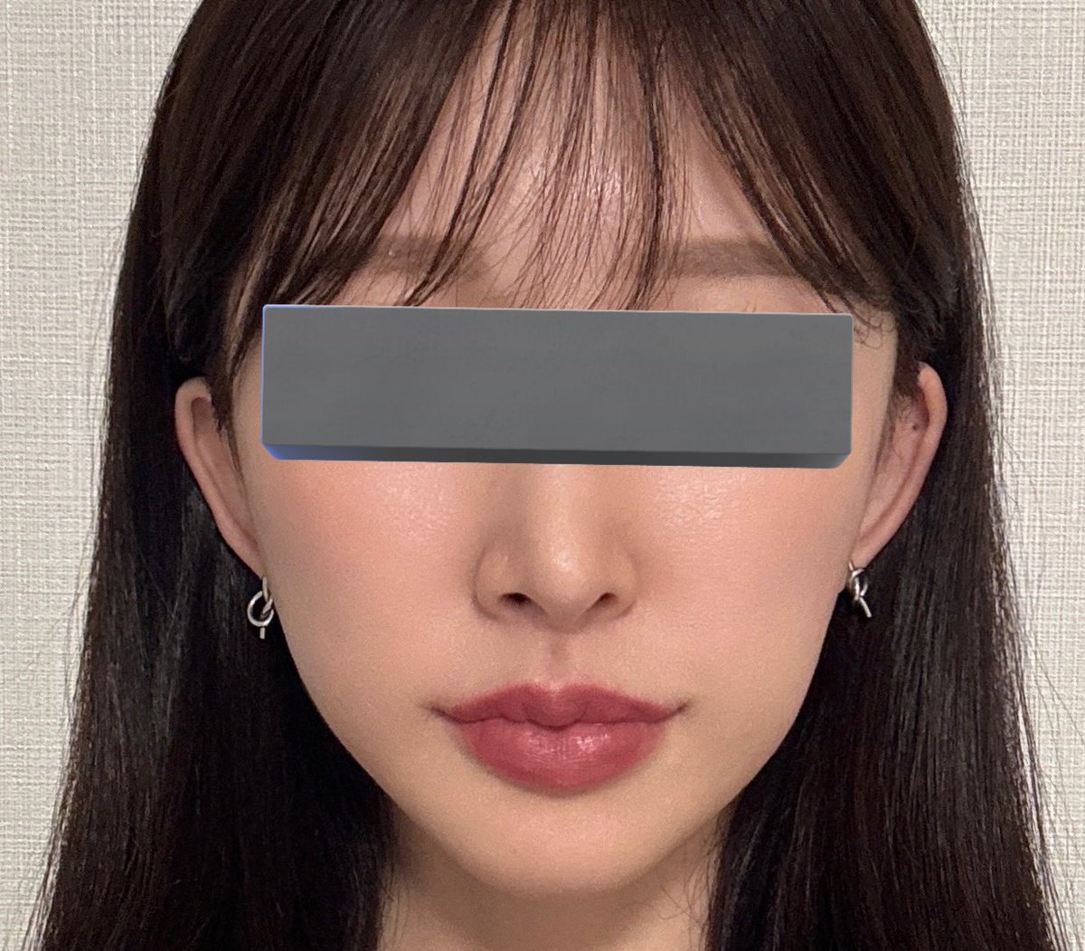 輪郭3点骨切りしてもうじき３年早い
全く後遺症なし
見返してたら１年目くらいまでは腫れ、むくみ残ってた感じする
すげえええ