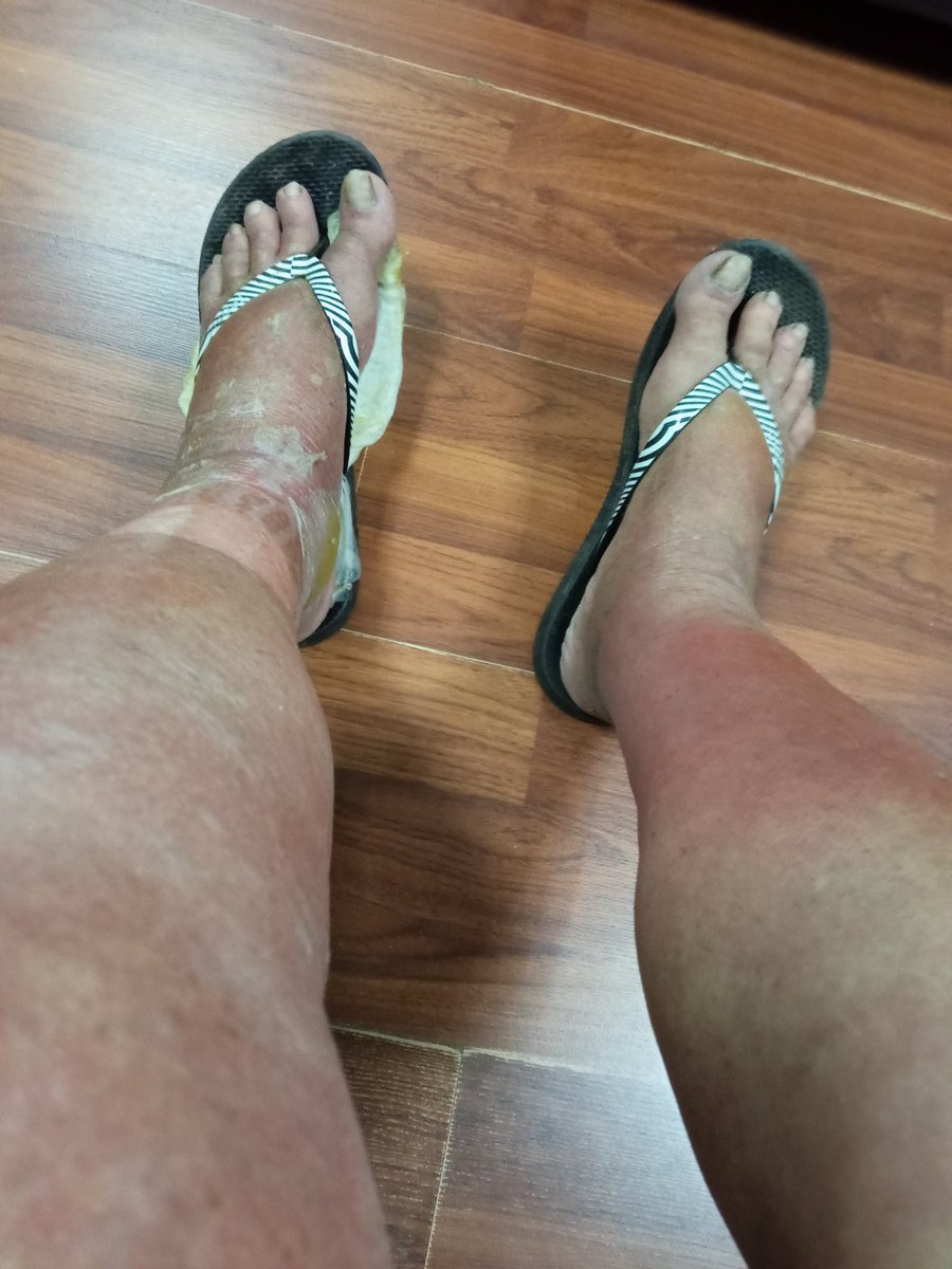 Alberguenieves's tweet image. Mis piernas hoy