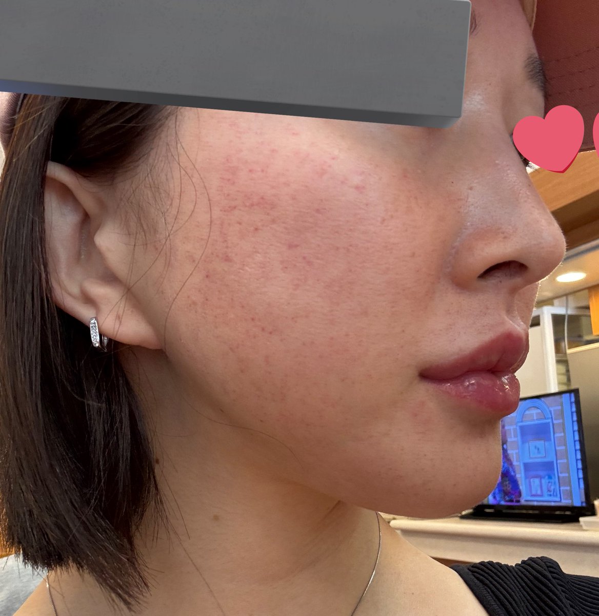 ノマカメ無加工、
ピコトーニング+ピコフラクショナル後で点状出血ひどい😭🙏

横顔もめちゃくちゃマシになった😇

輪郭3点、鼻先修正、フルフェイス切開リフトとか。