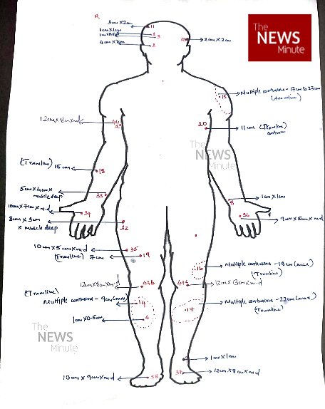 ambedkariteIND's tweet image. #PoliceBrutality Tortured to Death in Custody, Ajith Kumar, 29, taken by Tamil Nadu police, never came back. Post-mortem reveals 44 external injuries &amp;amp; internal bleeding. A chilling reminder: Justice dies when silence wins. #CustodialDeath #JusticeForAjith