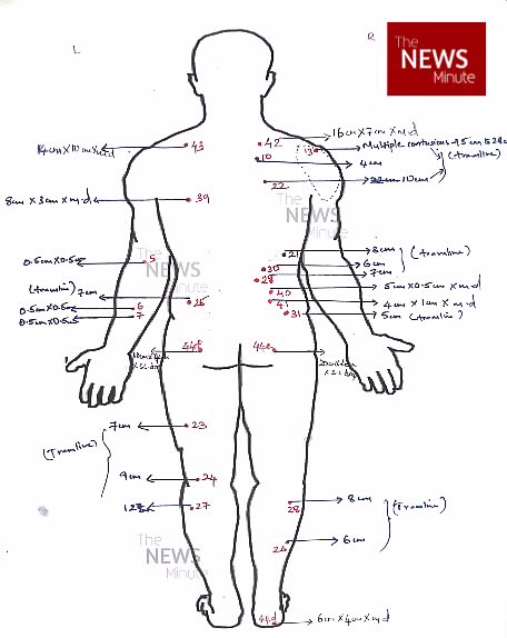 ambedkariteIND's tweet image. #PoliceBrutality Tortured to Death in Custody, Ajith Kumar, 29, taken by Tamil Nadu police, never came back. Post-mortem reveals 44 external injuries &amp;amp; internal bleeding. A chilling reminder: Justice dies when silence wins. #CustodialDeath #JusticeForAjith