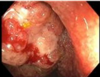 HabibToni's tweet photo. 🚨 Just published! Our latest case report uncovers DIC as an unusual early presentation in ulcerative colitis. Check it out for insights into this complex condition.
#MedicalResearch #UlcerativeColitis #DIC #Gastroenterology #GITwitter 

https://t.co/UaiUjp6CU3 https://t.co/TTxJqyL6fS