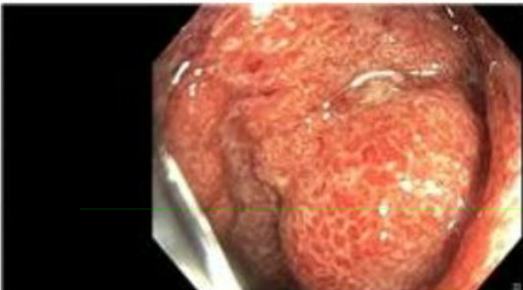 HabibToni's tweet photo. 🚨 Just published! Our latest case report uncovers DIC as an unusual early presentation in ulcerative colitis. Check it out for insights into this complex condition.
#MedicalResearch #UlcerativeColitis #DIC #Gastroenterology #GITwitter 

https://t.co/UaiUjp6CU3 https://t.co/TTxJqyL6fS