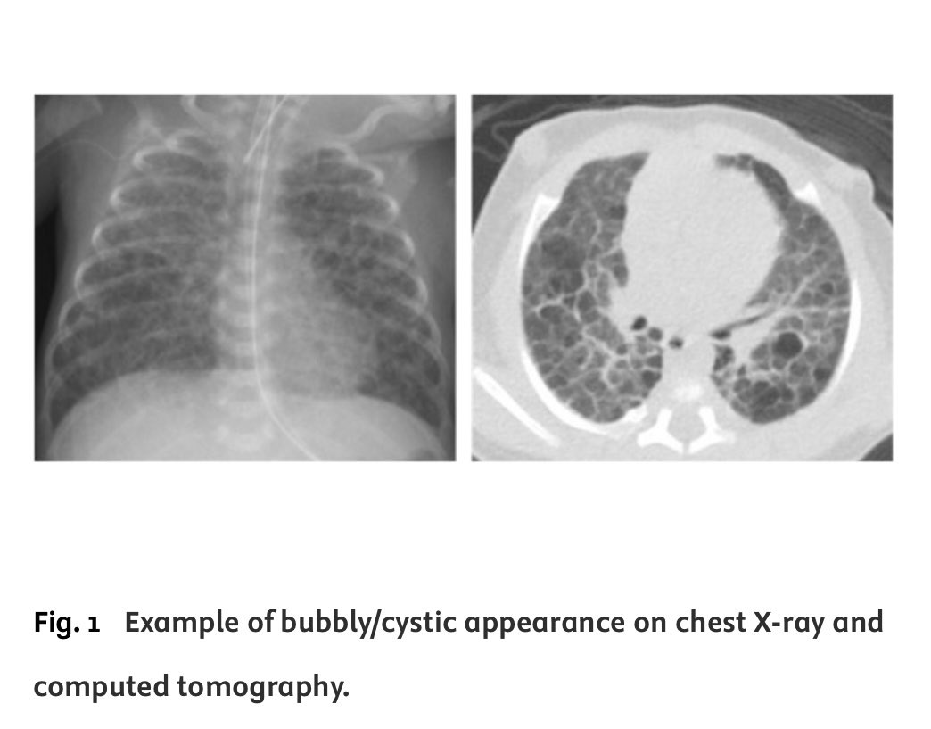 JAPANicu's tweet image. Hirata, et al. reported that bubbly/cystic CXR findings and SGA status, key components of the revised Japanese BPD classification, were significantly associated with long-term pulmonary function abnormalities in extremely preterm infants.
pediatr-neonatol.com/article/S1875-…
#neotwitter