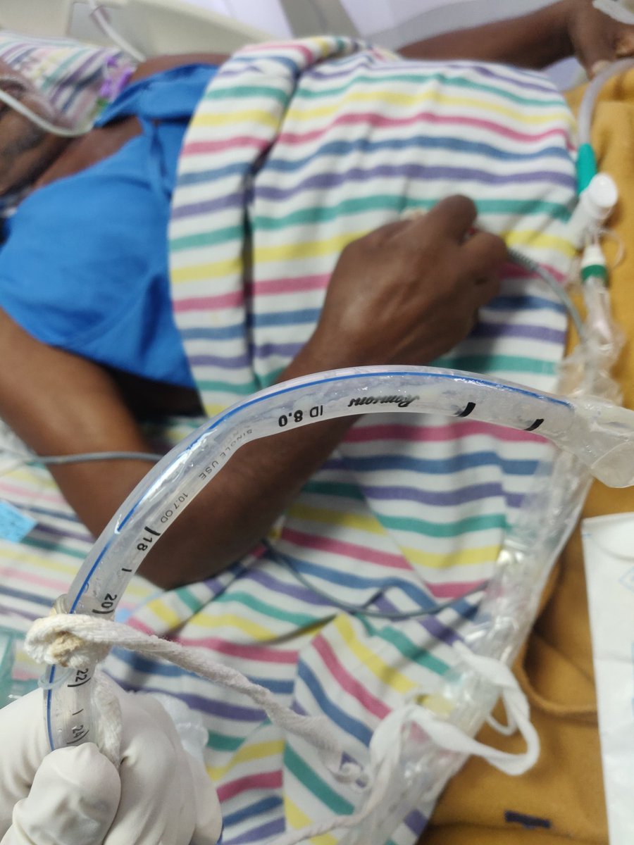 drvimalzenICU's tweet image. Tube Kinking - All possible Dysynchronies
#VentilatorGraphics
#Endotrachealtubeblock
#Dysynchrony