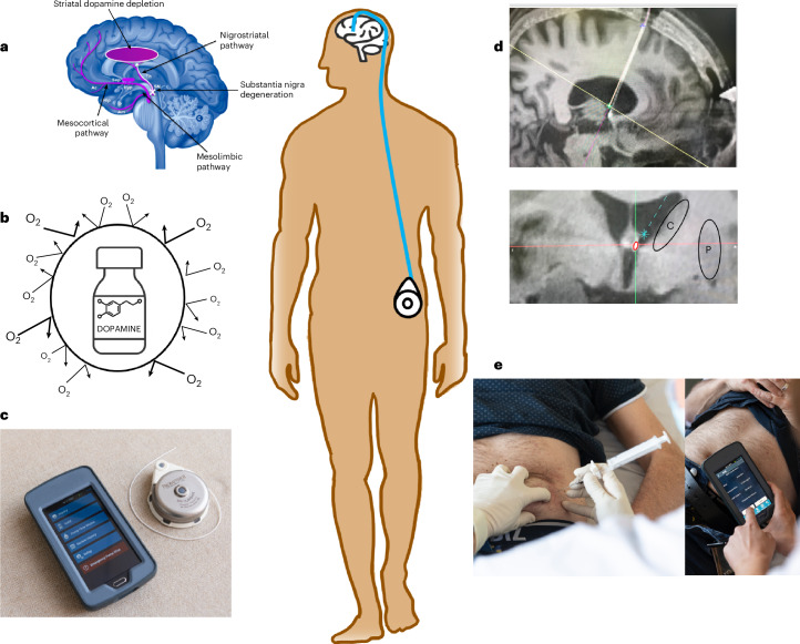 piandro3142's tweet image. This is a really cool potentially new treatment for Parkinson disease: intracerebroventricular administration of anaerobic dopamine via an abdominal pump connected to a subcutaneous catheter implanted in the third ventricle (near the striatum). pmc.ncbi.nlm.nih.gov/articles/PMC11…