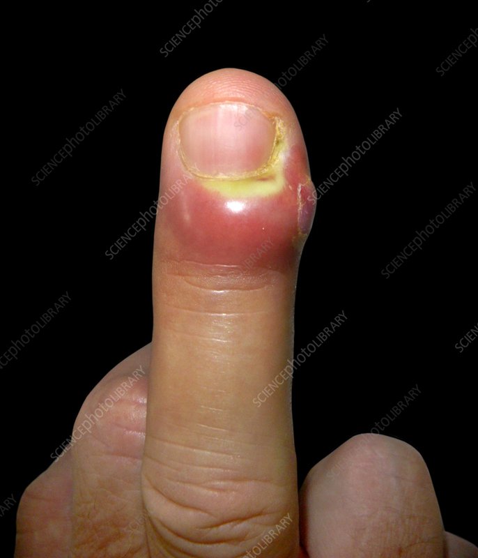 Paronychia.
Paronychia is a skin infection that occurs around the nail. It can affect the fingernails or toenails.