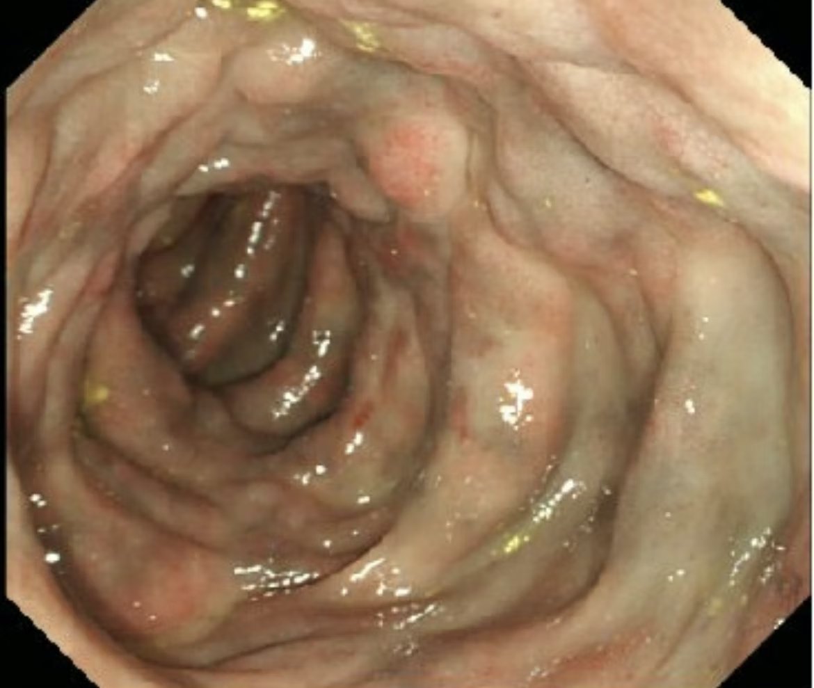 EndoCollab™ | GI Endoscopy Community tweet media