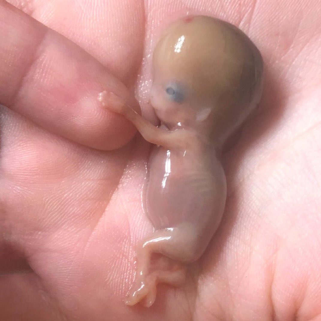 El pequeño Lennon ha fallecido recientemente a las 10 semanas de gestación debido a un aborto espontáneo. Su madre con profundo amor y valentía ha querido compartir esta imagen para mostrar al mundo la verdad: la humanidad de su hijo y la de todos los niños en el vientre materno.