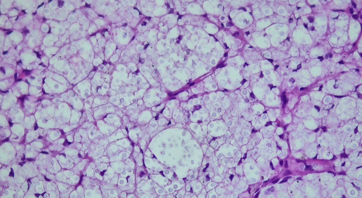 A 51-year-old male patient with a 4 cm mass in the right upper lobe of the lung  #lungpathology #pathology