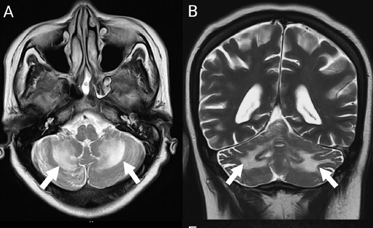 AtaxiasARG's tweet image. Cerebellar involvement in #HIV is typically associated with opportunistic infections or neoplasia. This case illustrates that bilateral #cerebellar dysfunction can represent the first clinical manifestation of HIV infection
#ataxia
link.springer.com/article/10.100…