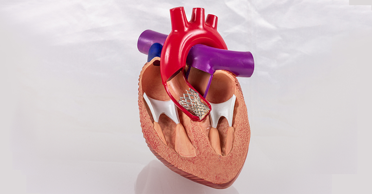 Guidelines in Practice from Medscape (@ginp_medscape) on Twitter photo TAVR, Alternative Access: SCAI Consensus Statement
ms.spr.ly/6011SNOpx TAVR, Alternative Access: SCAI Consensus Statement
ms.spr.ly/6011SNOpx