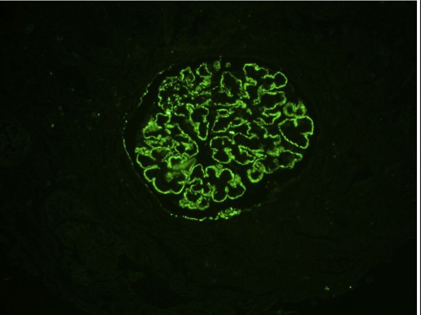 #RenalPath: Diffuse granular capillary wall staining for phospholipase A2 receptor (PLA2R). PLA2R staining is positive in approximately 70% of patients with clinically idiopathic membranous nephropathy (immunofluorescence microscopy, PLA2R). 

bit.ly/2xVkJzs (FREE)