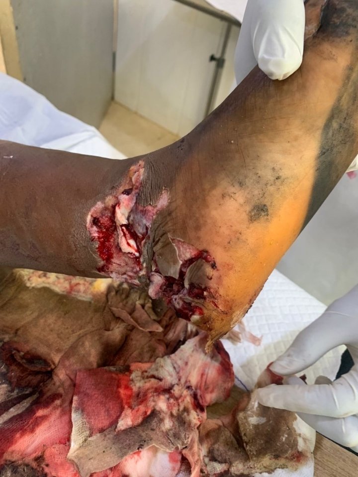 This person got bitten by a puff adder. Instead of going to the hospital, he went to a local herbalist, who doesn't know what they're doing by the way. As I type this, the person's leg has been amputated.

If you ever get bitten by any snake, please take a picture if you can. If