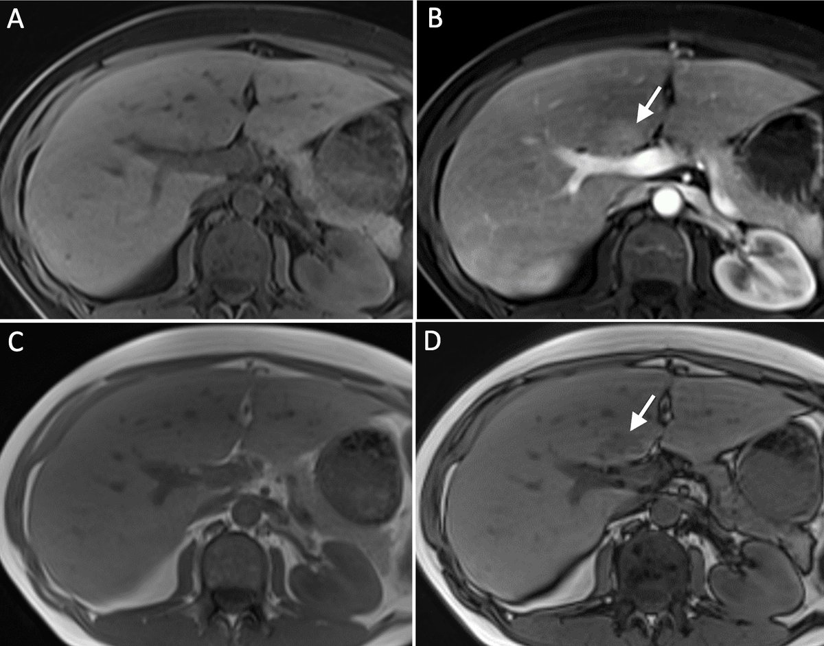 MedBlendPub's tweet image. 💡#ImagingPearls - Third Inflow
🔹Aberrant veins (right gastric vein below) bringing non-portal, non-arterial blood into the liver
🔹Focal enhancement or fat deposition that mimics pathology
🔹Key clue: signal loss from in to opposed-phase MRI (C,D)
#MedTwitter #Radres #MRI